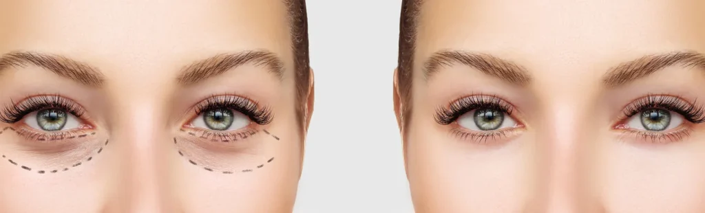 درمان قطعی تیرگی زیر چشم 6روش+معرفی بهترین محصولات داروخانه‌