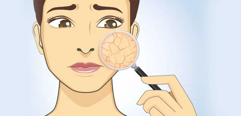 دلایل خشکی پوست در زمستان و راه‌های جلوگیری از آن