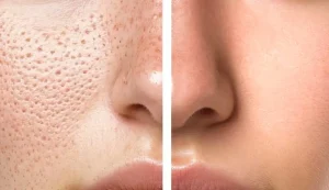 منافذ باز پوست را چگونه درمان کنیم؟