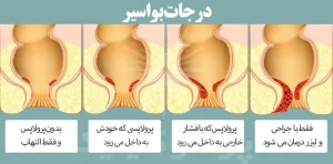انواع بواسیر کدام‌اند؟