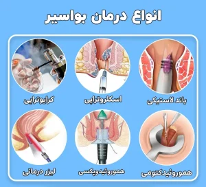 درمان بواسیر