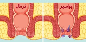 هموروئید یا بواسیر چیست؟