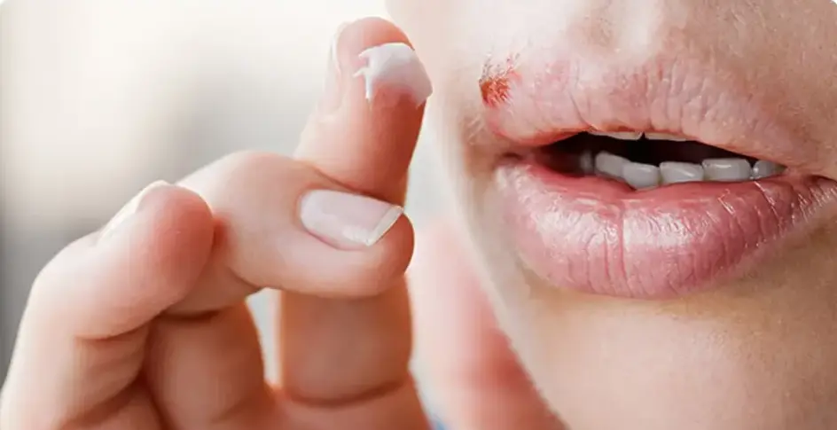 سریع‌ترین روش‌های درمان تبخال لب در خانه و داروخانه