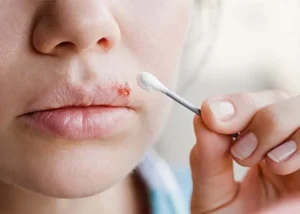 تبخال چیست و علت ایجاد آن کدام است؟