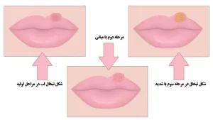 مراحل ایجاد تبخال لب